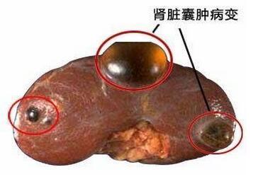 肾囊肿与先天性多囊肾的区别