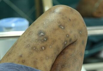 感染艾滋病后能活多久