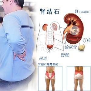 肾结石的形成原因