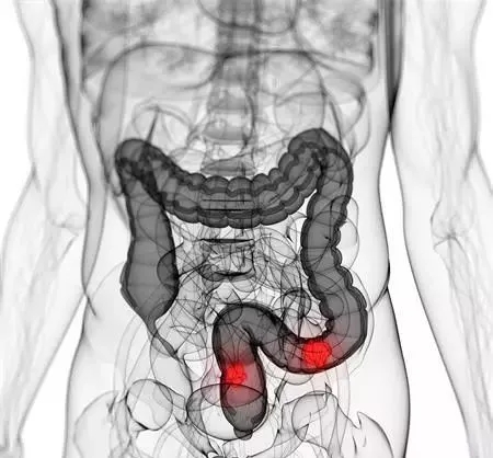 肠癌的3种治疗方法 肠癌能活多久？