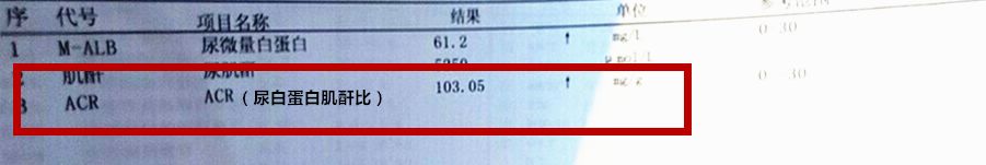 临床目前最常用尿蛋白肌酐比来反应尿微量白蛋白的水平