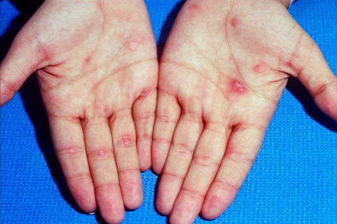 梅毒病人的护理与危害