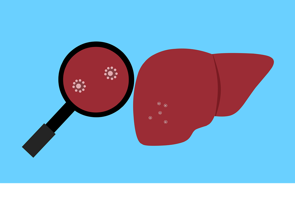 丙型肝炎如何保护肝脏防止病情恶化
